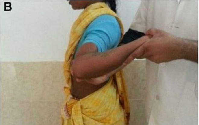 Kỳ lạ cô gái có khả năng xoay vai 180 độ vì lý do không tưởng Ảnh 2