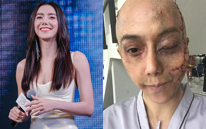 Shock với gương mặt bị hủy hoại, chằng chịt vết khâu của người đẹp 8X Thái Lan Ảnh 2