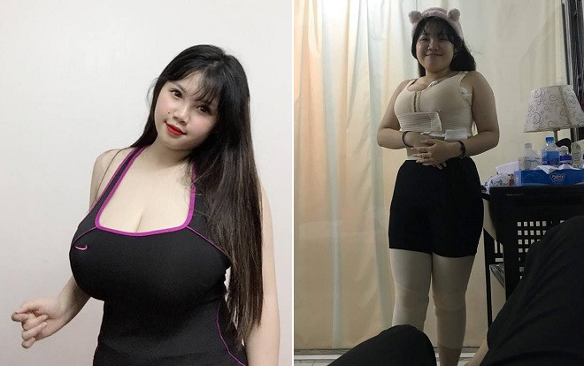 Nữ sinh 'siêu vòng 1' bất ngờ xuất hiện với thân hình eo ót sau khi hút 9 lít mỡ thừa Ảnh 2