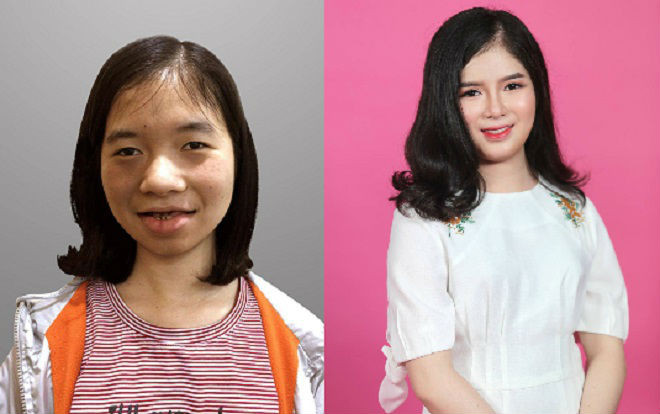 Cô gái bị gắn mác 'ma cà rồng',  suốt 18 năm không dám soi gương và hành trình 'lột xác' khiến nhiều người ngỡ ngàng Ảnh 2