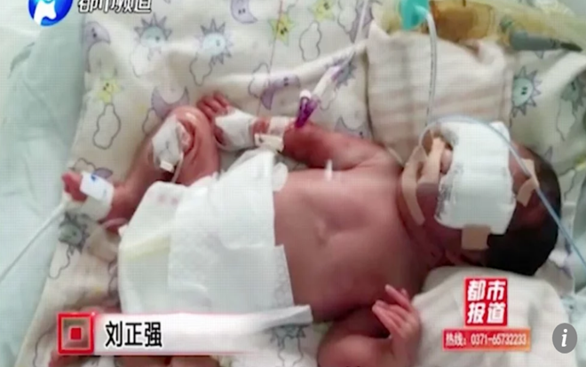 Thoát chết từ đám cháy, bị bỏng hơn 85% cơ thể, thai phụ vẫn ‘vượt cạn’ thành công Ảnh 2