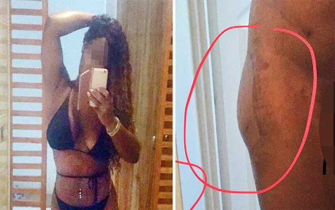 Vượt ngàn cây số để nâng mông làm đẹp, cô gái 'khóc ròng' với cái kết đắng Ảnh 2