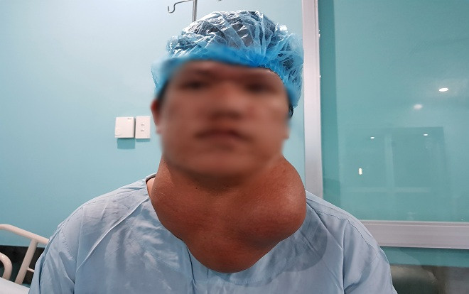 Người đàn ông mang khối bướu khổng lồ nặng 2 kg ở cổ suốt 25 năm Ảnh 2