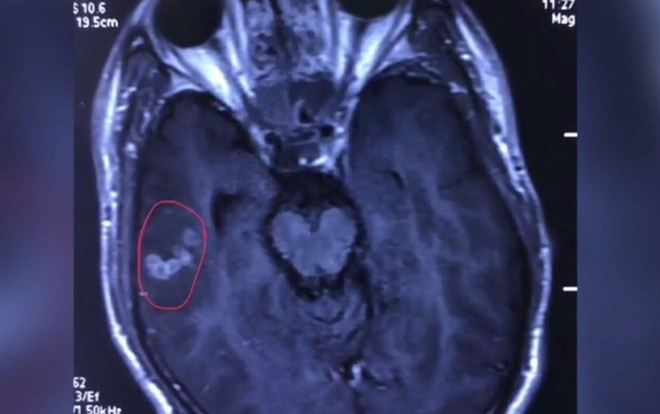 Sán dây dài 10 cm ký sinh trong não thanh niên 'nghiện' đồ nướng Ảnh 2