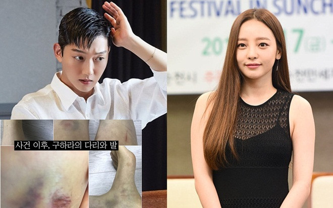 Dispatch đăng loạt ảnh thương tích trên người Goo Hara - Bác sĩ chuẩn đoán chảy máu tử cung và vùng kín do bị tấn công Ảnh 2