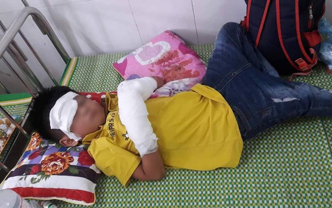 Bé trai dập nát 2 bàn tay vì điện thoại phát nổ Ảnh 2