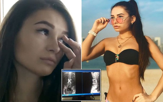 Nỗi ám ảnh của người mẫu nữ nhảy từ tầng 6 xuống đất để chạy trốn kẻ cưỡng hiếp Ảnh 2