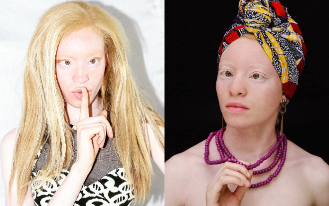 Đối thủ của Minh Tú ở Hoa hậu Siêu quốc gia là phụ nữ mắc bệnh Bạch tạng Ảnh 2