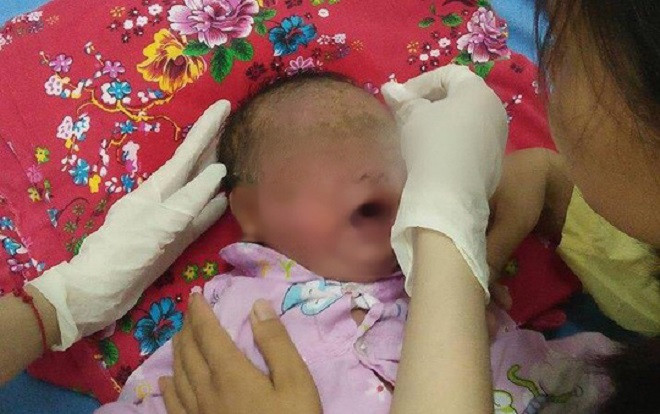 Quảng Ninh: Bé trai 32 ngày tuổi bị viêm loét toàn thân vì tắm lá Ảnh 2