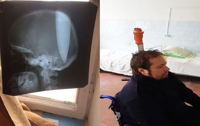 Kỳ cục: Người đàn ông tự đâm dao 20 cm vào đầu cho dễ thở Ảnh 2