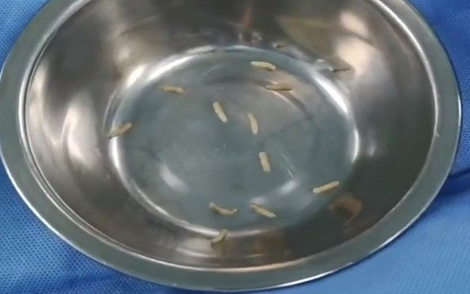 Rùng mình cảnh hơn 50 con giòi làm ổ, ăn thịt sống trên mặt bà lão Ảnh 2