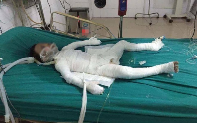 Hà Nội: Bé trai 6 tuổi bị bố dượng tẩm xăng đốt bỏng 98% đã qua đời Ảnh 2