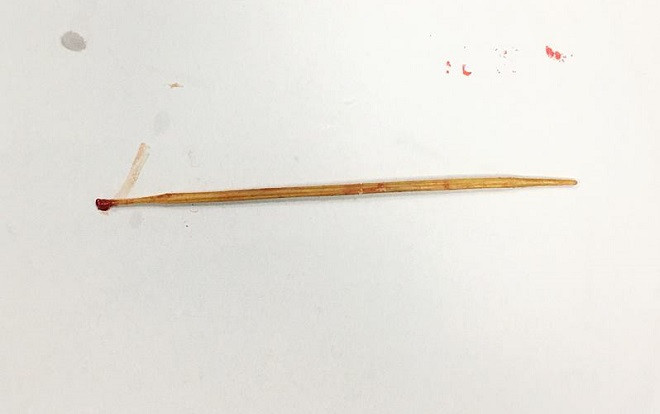 Phẫu thuật lấy que tăm dài 8cm ở vùng mông của bé trai 9 tuổi Ảnh 2