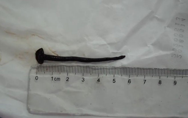 Ho ra máu 10 ngày liên tiếp, bác sĩ tá hỏa khi lôi ra thứ này trong cổ họng cô gái Ảnh 2