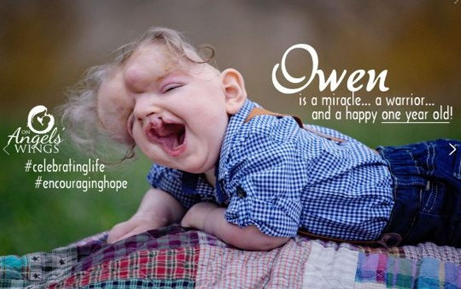 Phép màu kỳ diệu đến với cậu bé không hộp sọ dù bác sĩ chẩn đoán không sống nổi 1 ngày Ảnh 2