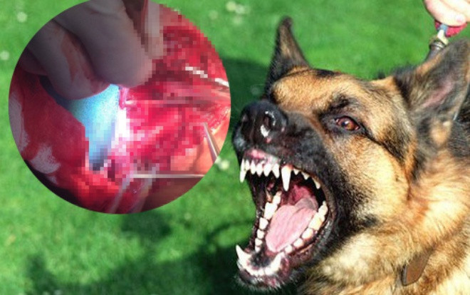 Kinh hoàng bé trai 2 tuổi bị chó Becgie 40kg nhà hàng xóm cắn đến rạn sọ, lòi nhãn cầu Ảnh 2