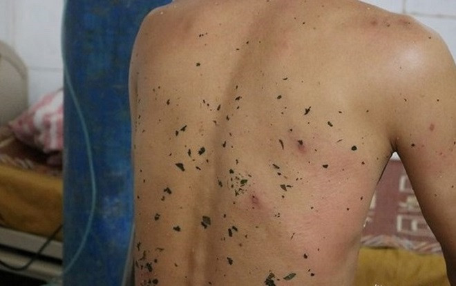 Nghệ An: 11 người thương vong do bị ong vò vẽ đốt Ảnh 2