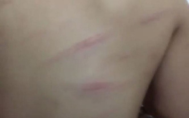 Gia đình phát hiện con học lớp 1 bị đánh bầm lưng, cô giáo giải thích do lười học Ảnh 2