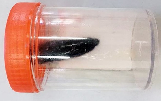 Kinh hãi đỉa chui vào đường thở cháu bé 9 tuổi Ảnh 2