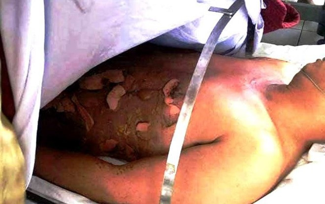 Nam thanh niên cháy nửa người khi đổ xăng lẻ ven đường Ảnh 2