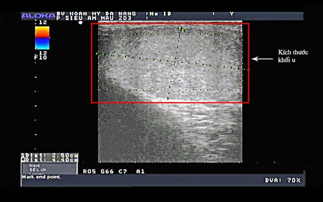 Hi hữu người đàn ông có 3 tinh hoàn ở Đà Nẵng Ảnh 2