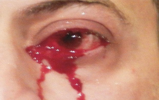 Người đàn ông bỗng nhiên chảy máu mắt vì bệnh hiếm Ảnh 2