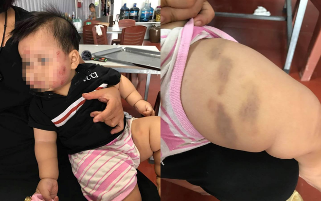 Phụ huynh bực tức tố con trai 11 tháng tuổi bị cắn khắp mặt, bầm tím khắp người sau khi đi gửi trẻ Ảnh 2