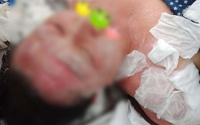 Liều mình thử phương pháp làm đẹp 'đốt cồn lên mặt', người phụ nữ bị bỏng nặng cháy hết tóc Ảnh 2