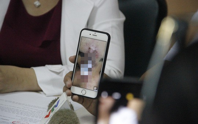 Nữ sinh Sài Gòn đau đớn vì bị biến dạng mũi sau khi tiêm chất làm đầy Ảnh 2