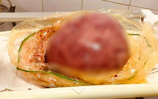 Gần 2 giờ đồng hồ phẫu thuật thành công khối u nặng hơn 4kg to tương đương thai 9 tháng Ảnh 2