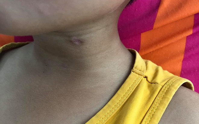 Anh nghịch súng săn của bố bắn xuyên cổ em trai nguy kịch Ảnh 2