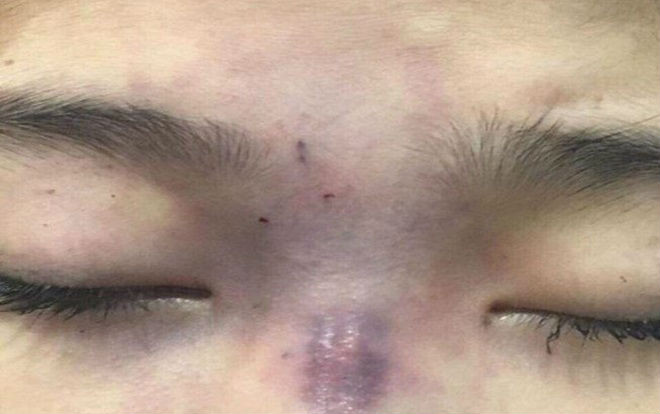 Vợ trẻ bị mù mắt phải, có nguy cơ hoại tử vùng da mũi sau khi được chồng tự tay tiêm chất làm đầy Ảnh 2