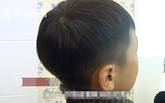 Vô tình chạm vào ngực cô giáo, bé trai 7 tuổi bị đánh thâm tím mặt mày Ảnh 2