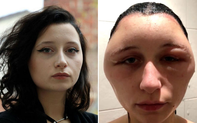 Cô gái 'tưởng như sắp chết', đầu bị biến dạng nặng nề vì thuốc nhuộm tóc mua qua mạng Ảnh 2