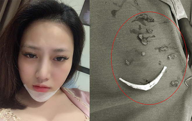 [Góc cảnh báo]: Lại thêm 1 vụ tiêm filler kém chất lượng, nạo nát mặt vẫn chưa hết tạp chất Ảnh 2
