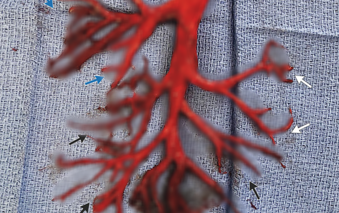 Bức ảnh người đàn ông Mỹ tử vong vì 'ho rơi cả phổi' được lan truyền trên mạng và sự thật bất ngờ phía sau Ảnh 2