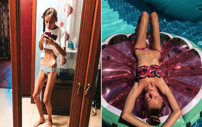 Nghe lời công ty người mẫu khuyên giảm cân, 2 nữ sinh song sinh hóa thành xác sống chờ chết ở bệnh viện Ảnh 2