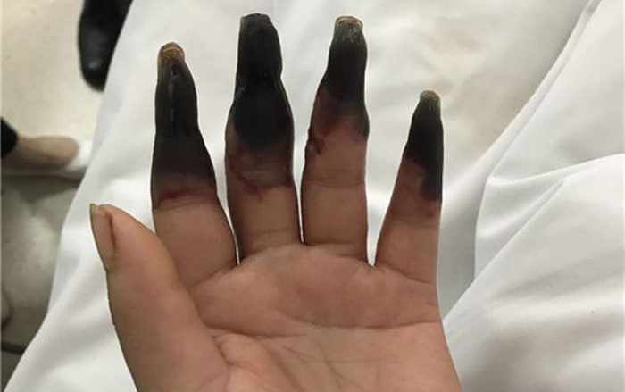Hai bàn tay bị hoại tử đen sì vì lý do nhiều người vẫn hay mắc phải Ảnh 2
