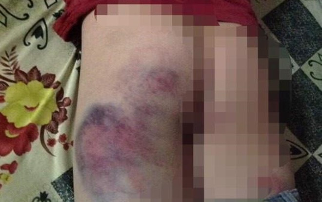 Xác minh vụ giáo viên chủ nhiệm đánh bầm tím mông học sinh vì không viết được bài Ảnh 2