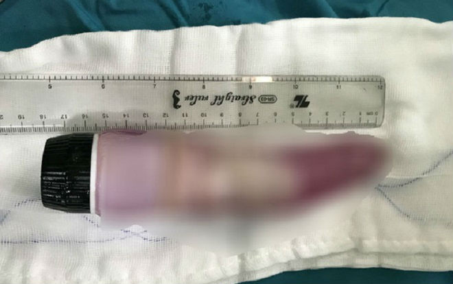 Hy hữu: Người đàn ông suýt chết vì nhét dương vật giả dài 18cm vào hậu môn gây tắc ruột Ảnh 2