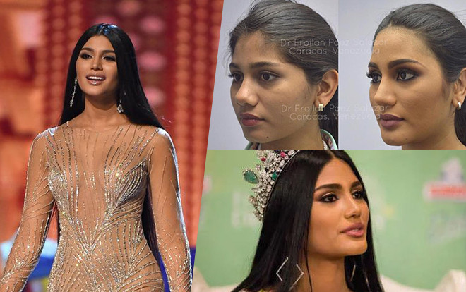 Á hậu Hoàn vũ người Venezuela công khai phẫu thuật thẩm mỹ như lột xác: Chỉ điều này còn 'nguyên sơ'! Ảnh 2