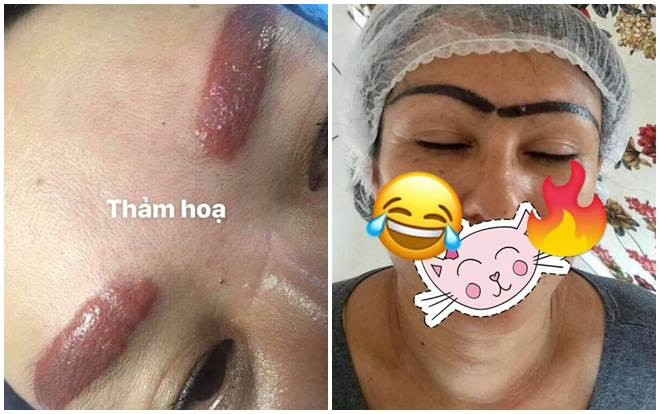 Ham rẻ, người phụ nữ rơi vào thảm họa xăm chân mày và để lại sẹo vĩnh viễn Ảnh 2