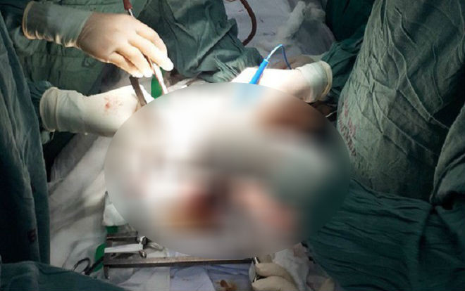 Cứu sống bệnh nhân bị thanh gỗ đập trúng ngực gây vỡ tim, máu phun xối xả Ảnh 2