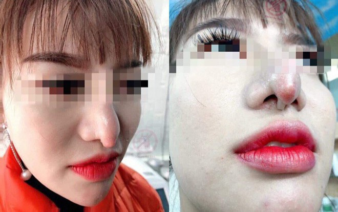 Chọn nhầm địa chỉ làm mũi dởm, cô gái “bất lực” với chiếc mũi khoằm tệ hơn bản gốc Ảnh 2