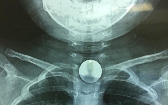 Bé gái 3 tuổi suýt mất mạng vì nuốt đồng xu chắn ngang cổ họng Ảnh 2