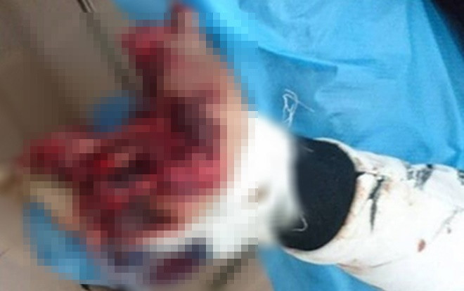 Dùng điện thoại khi đang sạc, thanh niên bị dập nát bàn tay Ảnh 2