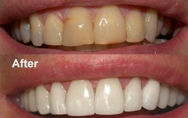 Để có hơi thở thơm tho, hàm răng trắng đều chơi Tết, hãy xắn tay lên và làm như thế này! Ảnh 2