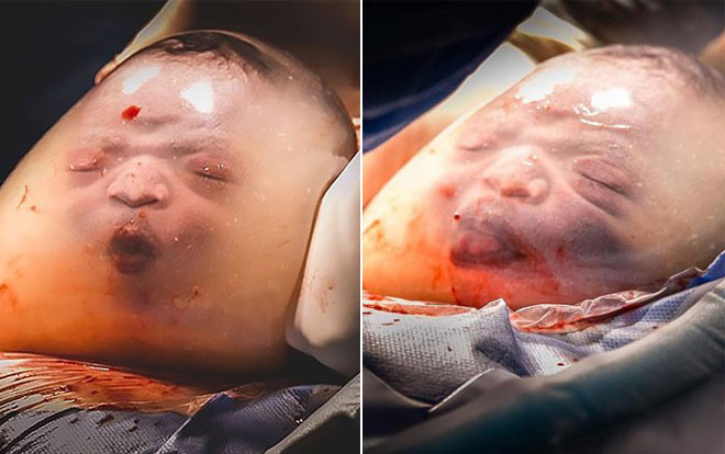Em bé bĩu môi khi chào đời nằm nguyên trong bọc ối Ảnh 2