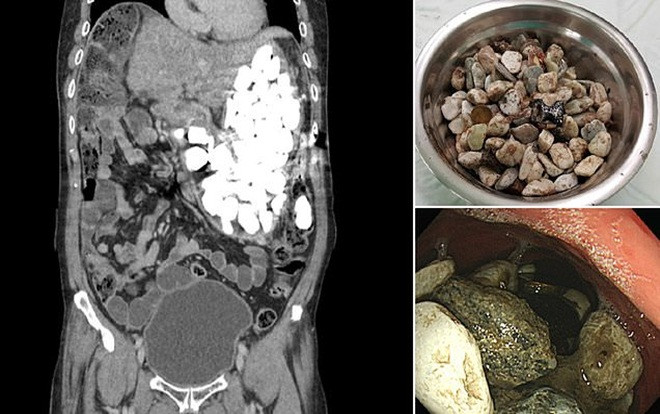 Người đàn ông nuốt 2 kg sỏi, nắp chai và đồng xu vì lý do không ngờ Ảnh 2