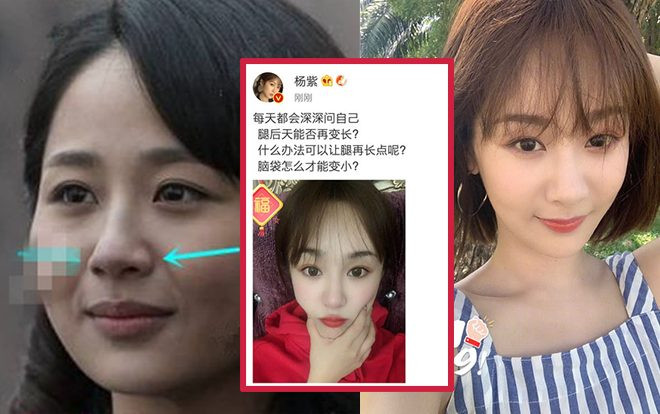 Dương Tử đăng ảnh 'chứng minh cằm thật', đáp trả tin đồn phẫu thuật thẩm mỹ Ảnh 2